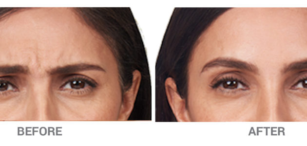 BeforeAfter-Botox1