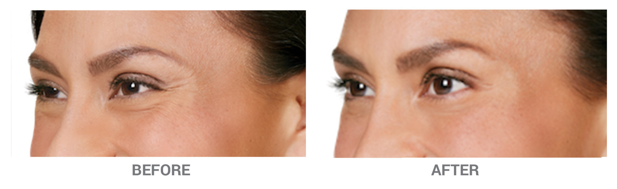 BeforeAfter-Botox2