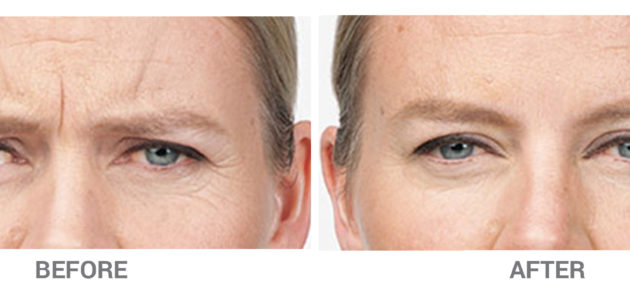 BeforeAfter-Botox3
