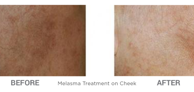 BeforeAfter-CosmeticLasers-6