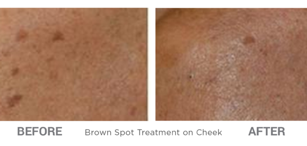 BeforeAfter-CosmeticLasers-7