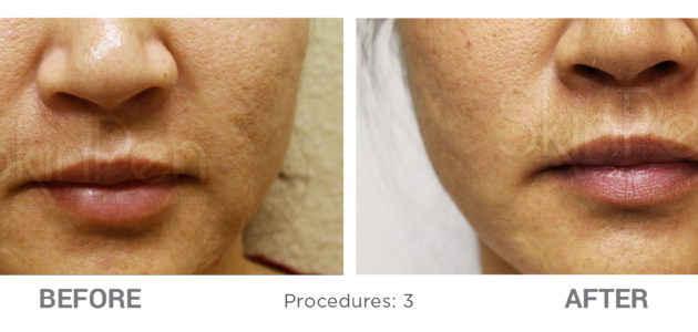 Microneedling-Before-After-1