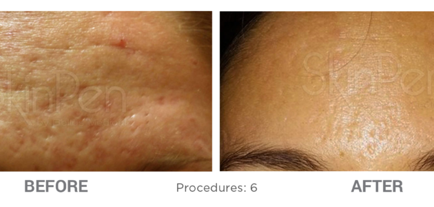 Microneedling-Before-After-2