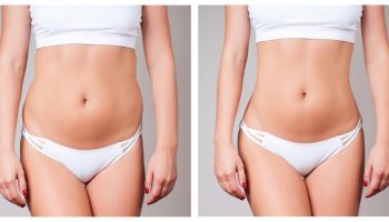 TruSculpt