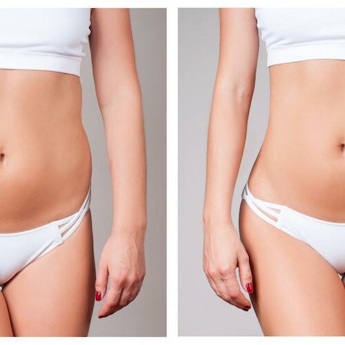 TruSculpt