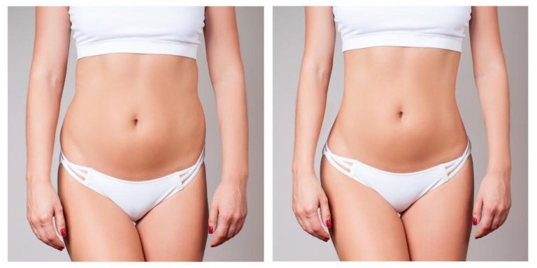 TruSculpt