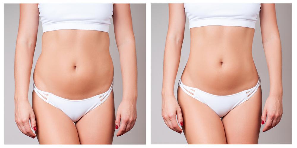 TruSculpt