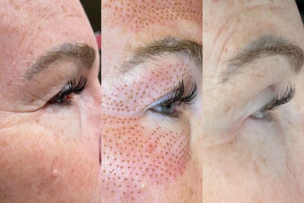 Fiberoblasting