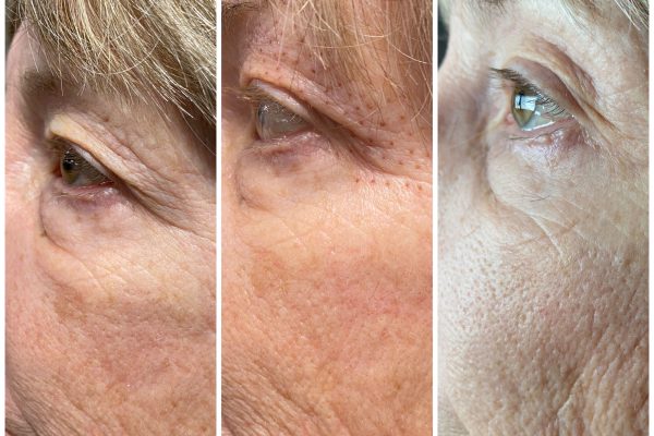 Fiberoblasting