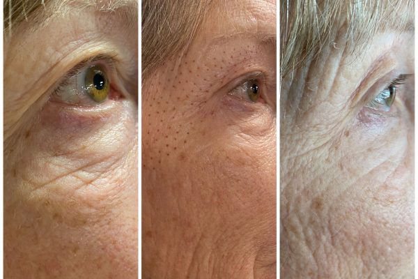 Fiberoblasting