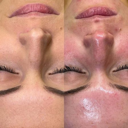 hydrafacial_3