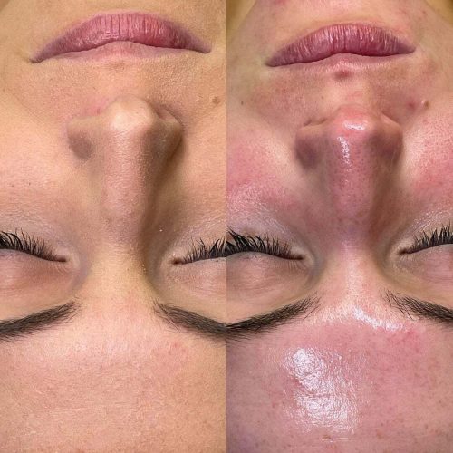 hydrafacial_3